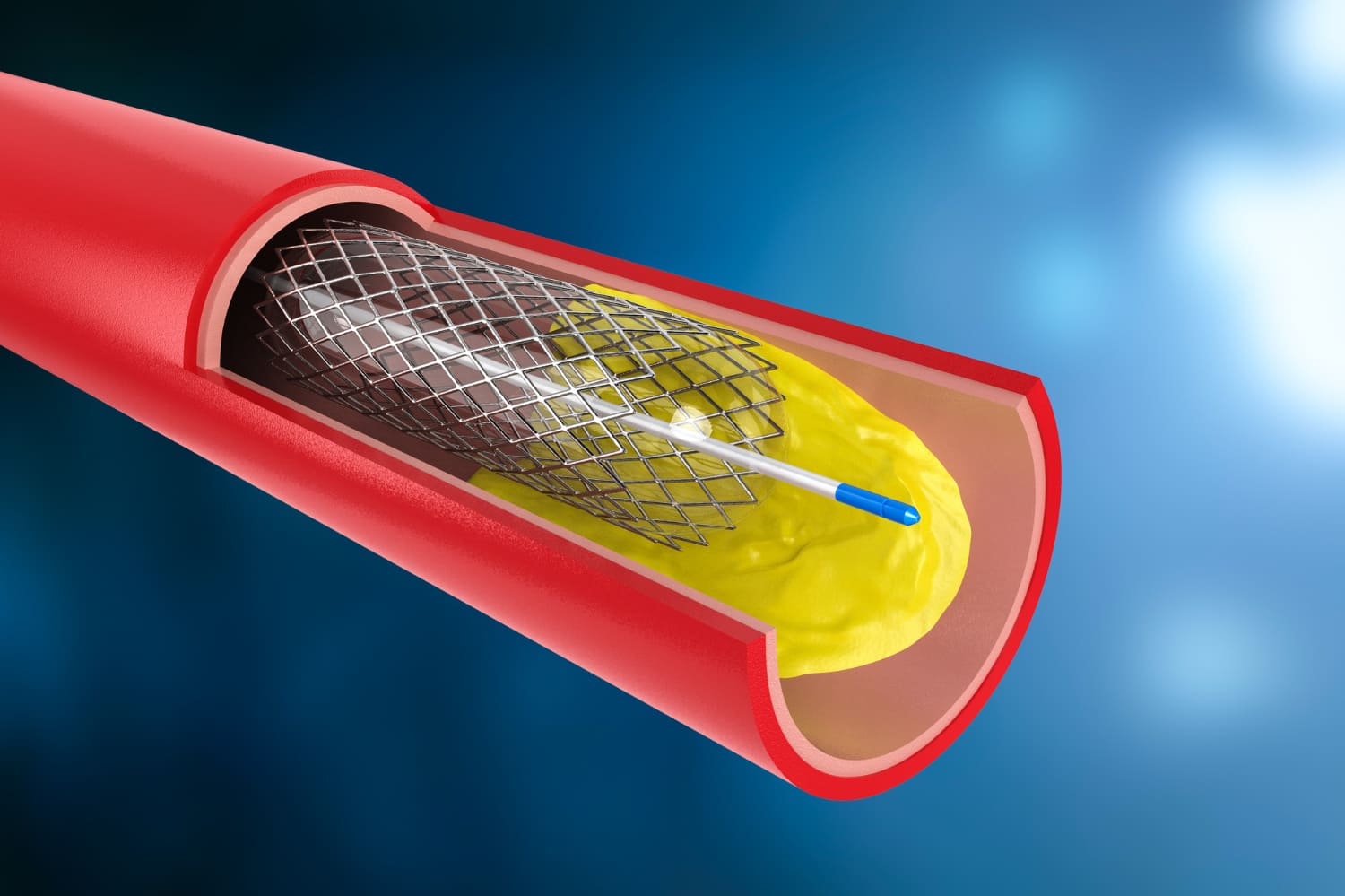 Prótesis valvular por cateterismo (TAVI) en Puebla: La alternativa menos invasiva para la válvula aórtica